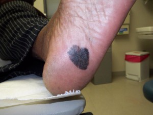 Imagen ejemplo de melanoma en piel de color. Mancha oscura de un solo color, del tamaño de dos cuartos, en la planta del pie, cerca del talón.